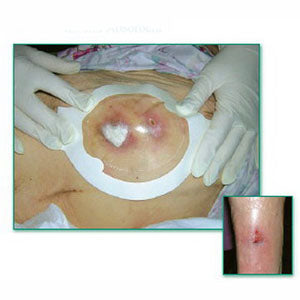 Tegaderm Clear Absorbent Acrylic Dressing 4-2/5" x 5" Oval 5 (BX)